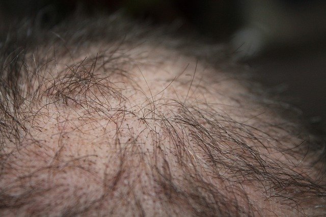 Ab wann ist eine Haartransplantation sinnvoll?